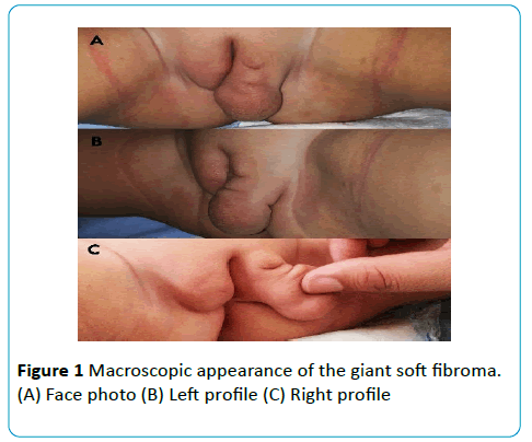 Cyst on the outer clitoris