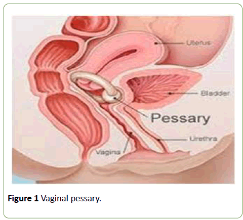 gynecology-obstetrics-Vaginal-pessary
