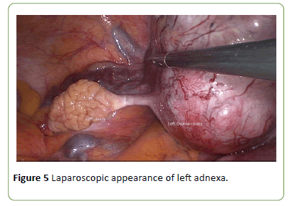 Uterine Myoma In A Rudimentary Horn Miming An Adnexal Neoplasm In Pregnancy Successful Delivery After Laparoscopic Resection At 14 5 Weeks Pregnancy A Case Report Insight Medical Publishing