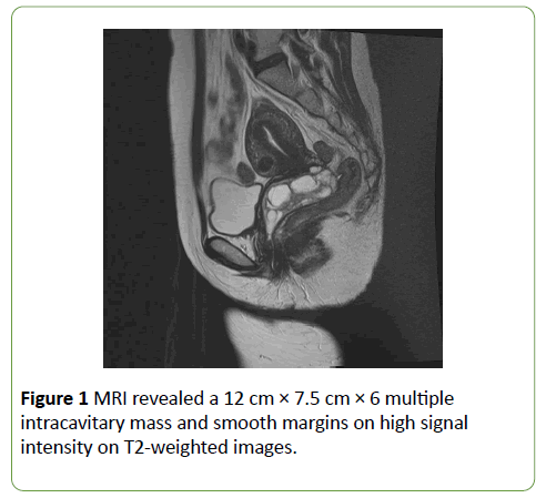 Giant Polyp Of Uterine Cervix A Case Report And Brief Literature Review Insight Medical Publishing